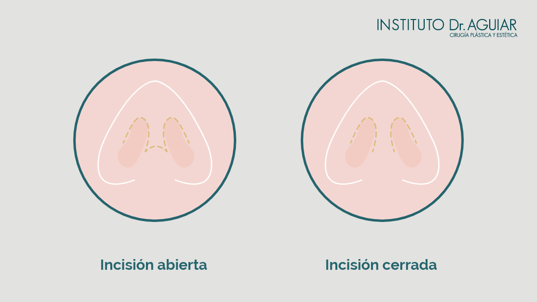 rinoplastia dudas frecuentes