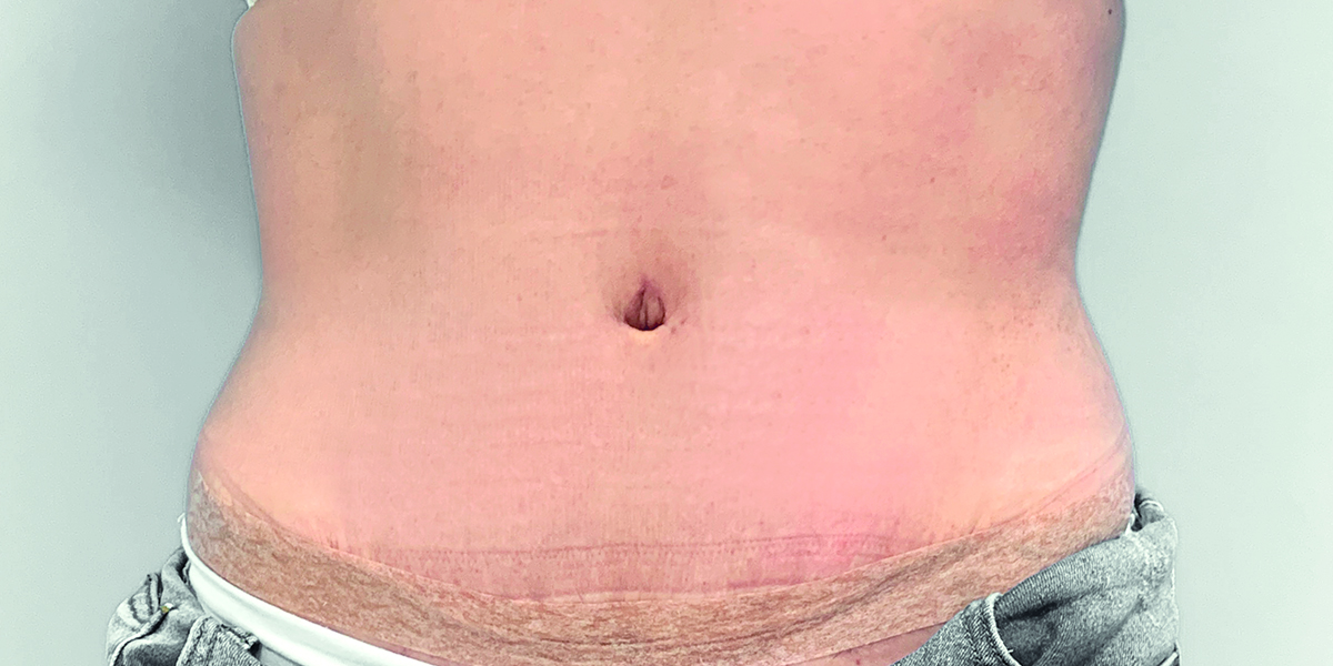 After-Abdominoplastia1