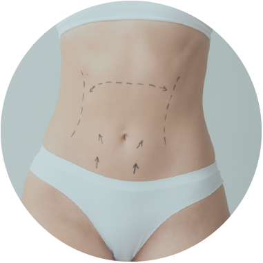 Tratamiento: Abdominoplastia