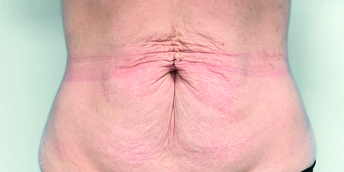 Before-Abdominoplastia1