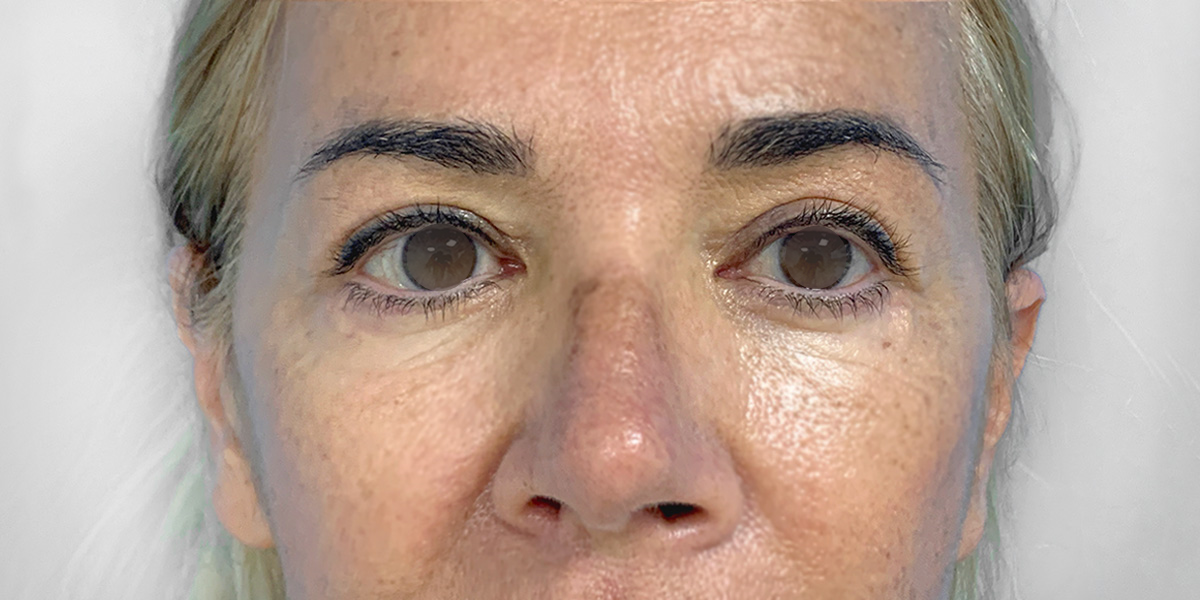 After-Blefaroplastia Completa