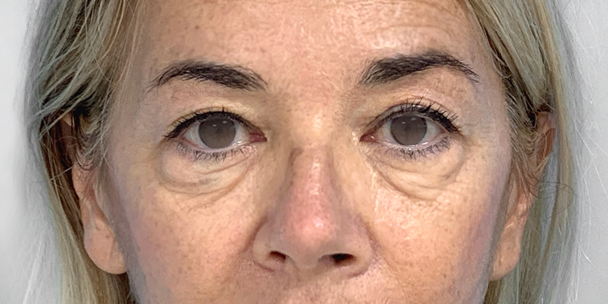 Before-Blefaroplastia Completa