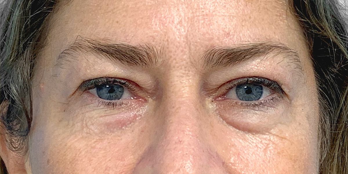 Before-Blefaroplastia interior