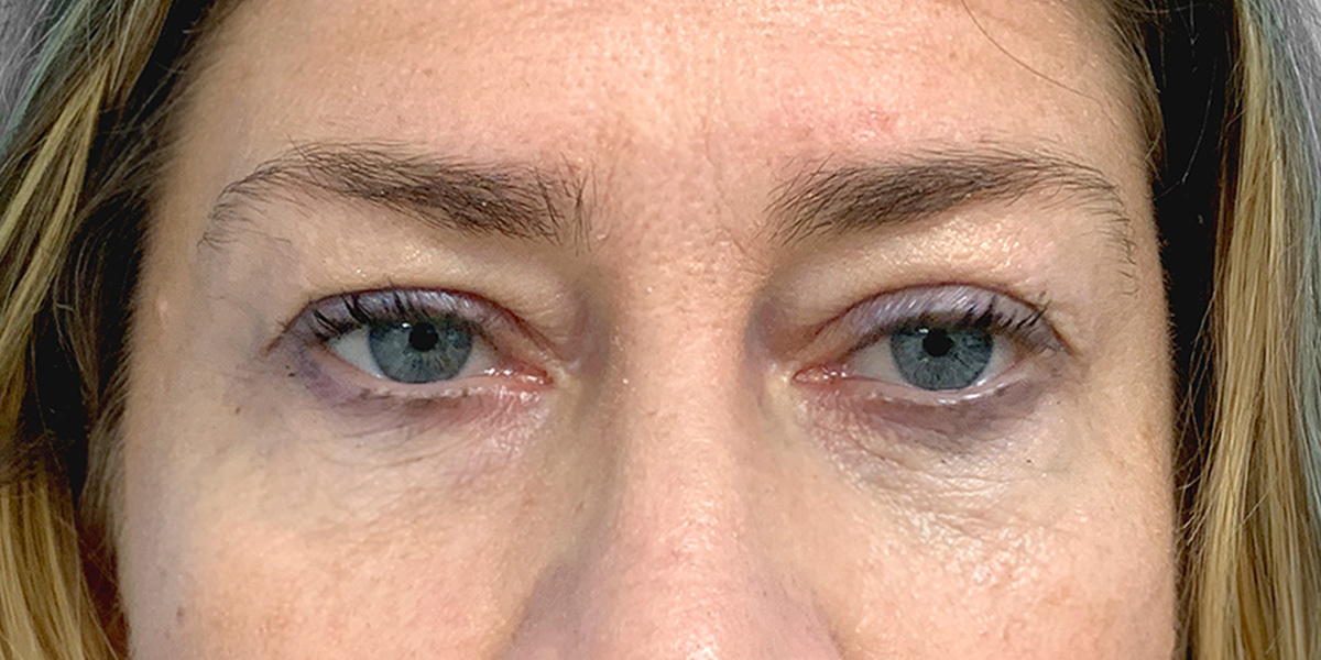 After-Blefaroplastia interior