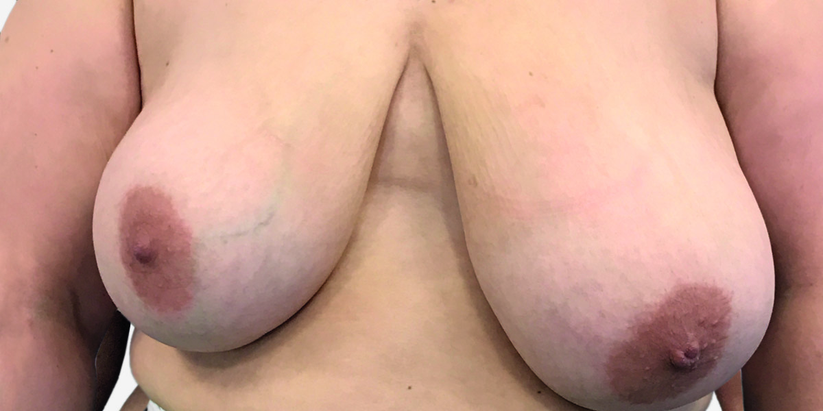 Before-Reducción mamaria 1
