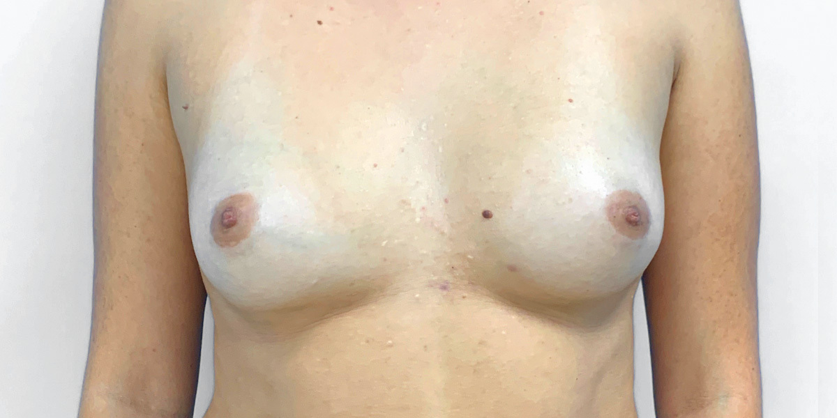 Before-Mamoplastia 1