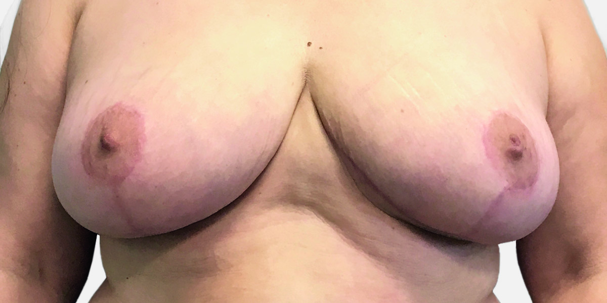 After-Reducción mamaria 1