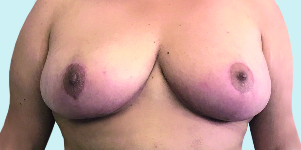 After-Reducción mamaria 2