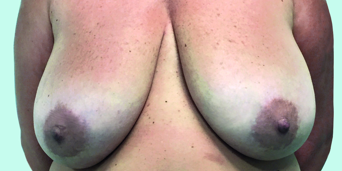 Before-Reducción mamaria 3