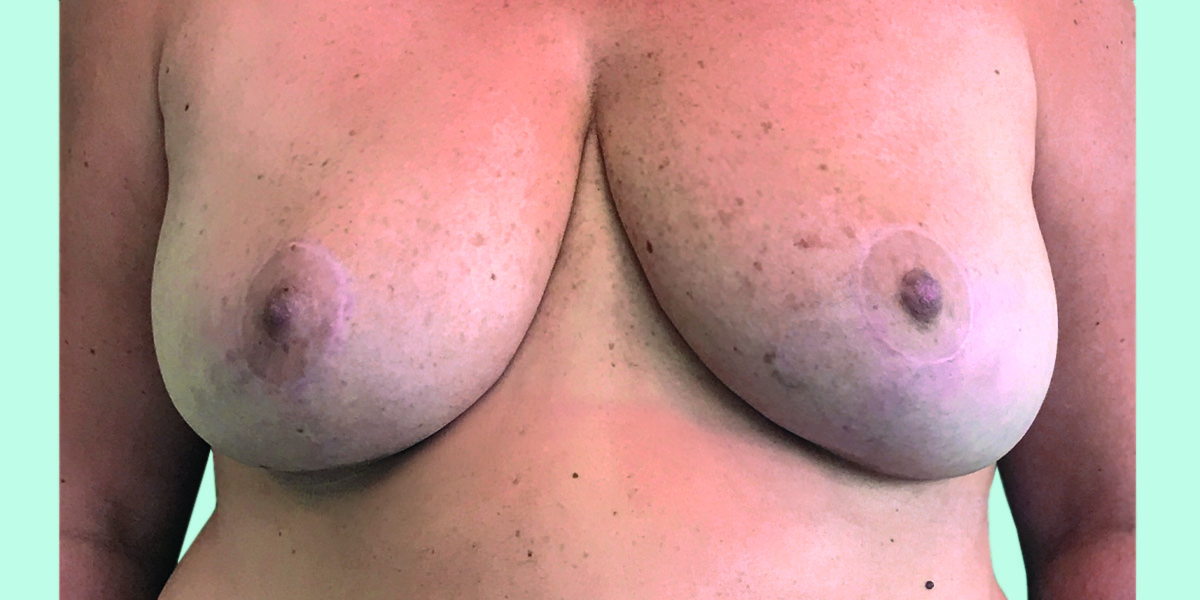 After-Reducción mamaria 3